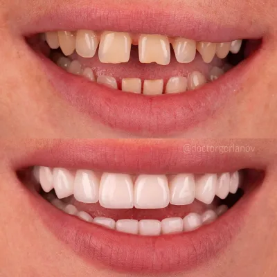 Book Dental Veneers Appointment in Islamabad