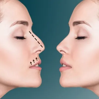 Book a Rhinoplasty Consultation in Islamabad