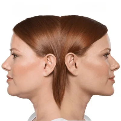 Does Chin Reduction Cost Depend on the Surgeon’s Experience?