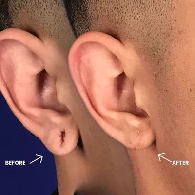 Earlobe Correction in Islamabad