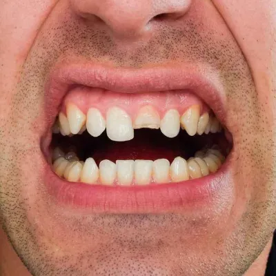 Fractured Teeth Treatment in Islamabad