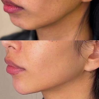 How Long Does Chin Reduction Last?