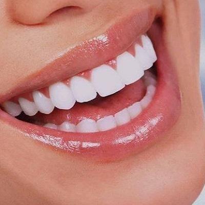 Is laser better than Normal Teeth Whitening?