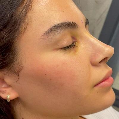 Rhinoplasty for Small Nose in Islamabad