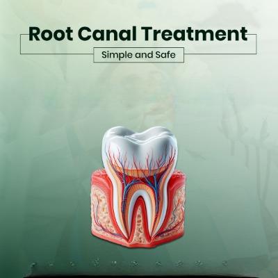 Root Canal Treatment in Islamabad – Cost, Procedure, & Benefits