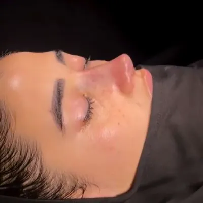 What Do Rhinoplasty Results Look Like After 3 Months