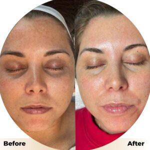 hydrafacial