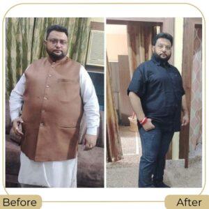 Best Bariatric Weight Loss Surgeon in Islamabad, Pakistan