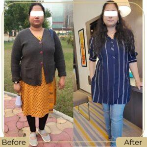 Best Bariatric Weight Loss Surgeon in Islamabad, Pakistan before