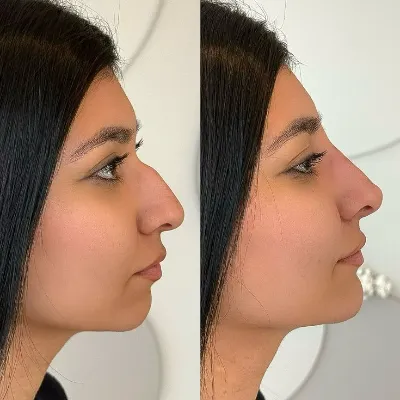 Can Rhinoplasty Results Change After 1 Year?