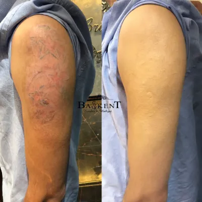 Can Tattoo Removal Really Erase Old or Faded Ink Safely?