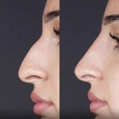 Cosmetic Rhinoplasty in Islamabad, Pakistan