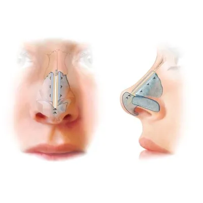 Fix Big Nose with Rhinoplasty in Islamabad