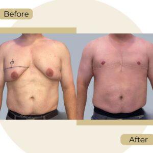 Gynecomastia in Islamabad