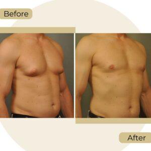Gynecomastia in Islamabad before after
