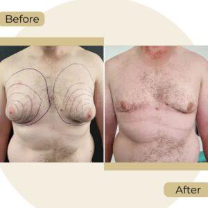 Gynecomastia in Islamabad rawalpindi