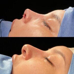 Is Nose Reshaping Surgery Permanent or Temporary