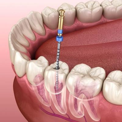Islamabad Root Canal: Fast Relief for Pain?