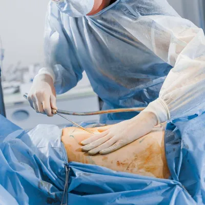 Liposuction vs. Non-Surgical Fat Reduction