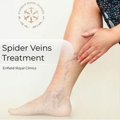 Spider Veins Treatment in islamabad
