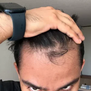 Tirzepatide Weight Loss Injection in Pakistan