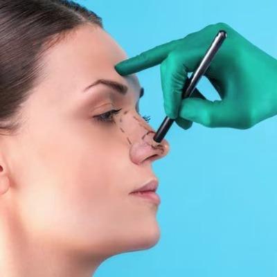 What Happens in the First Week After Rhinoplasty
