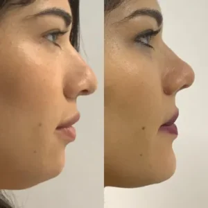 What Is the Latest Rhinoplasty Procedure Available