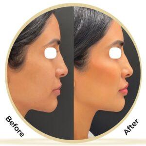 cheek augmentation