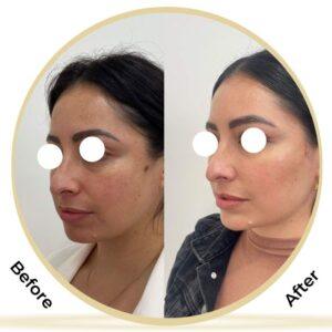 cheek augmentation after