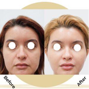 cheek augmentation before