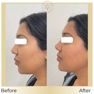 double chin before after