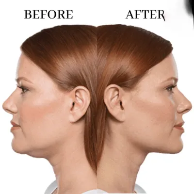 double chin treatment in islamabad rawalpindi
