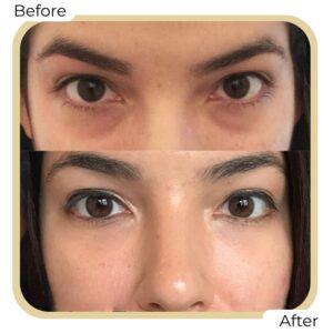 eye bag removal