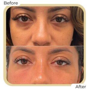 eye bag removal in islamaabd rawalpindi