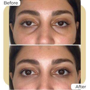 eye bag removal in islamabad
