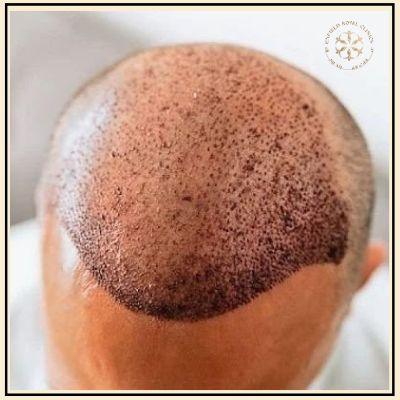 hair transplant in islamabad