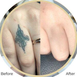 laser tatoo removal after