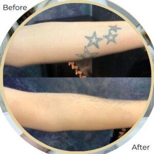 laser tatoo removal before