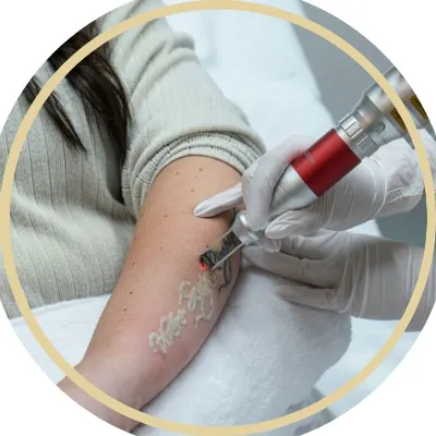 laser tatoo removal in islamabad