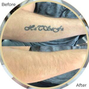 laser tattoo removal islamabad paksitan