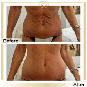 liposuction
