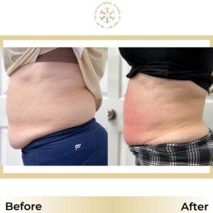 liposuction before after