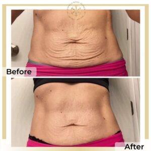 liposuction islamabad