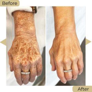 melasma treatment