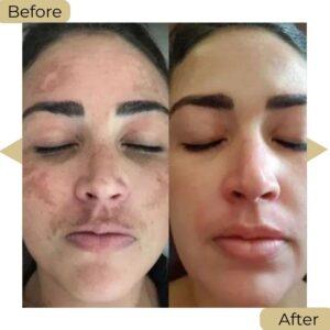 melasma treatment in islamabad pakistan
