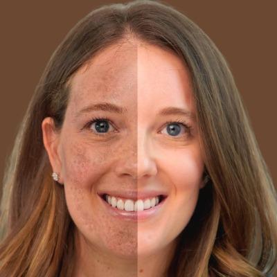 melasma treatment in islamabad