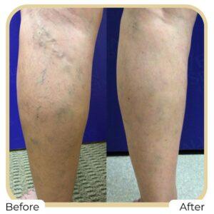 spider veins