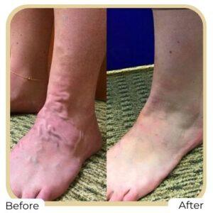 spider veins after before