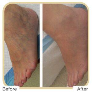 spider veins before