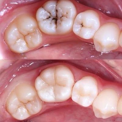 teeth filling in islamabad